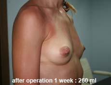 plastic-surgery-breast-augmentation 